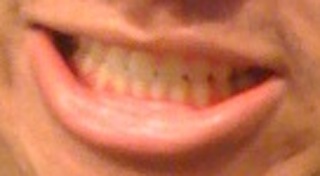 Teeth after braces
